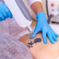 Is Laser Tattoo Removal Safe?